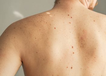 AI melanoma detection