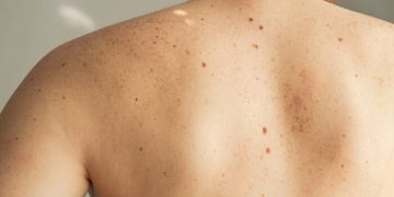 AI melanoma detection