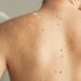 AI melanoma detection