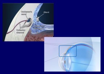 eye ointments glaucoma implants