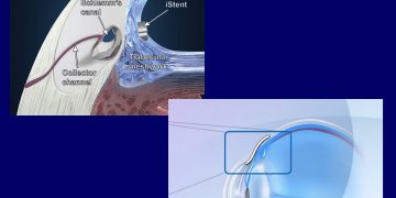 eye ointments glaucoma implants