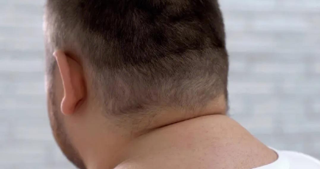 How To Get Rid Of Neck Hump