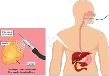 Pancreatic cancer treatment