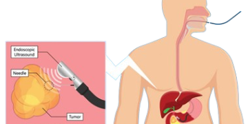 Pancreatic cancer treatment